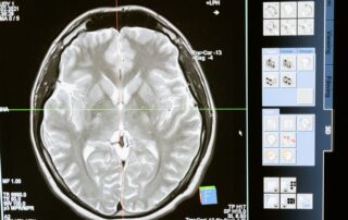 Intricate MRI brain scan displayed on a computer screen for medical analysis and diagnosis.